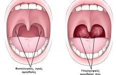 “Όπλο  στην φαρέτρα” τους κατά του καρκίνου του στόματος-στοματοφάρυγγα διαθέτουν  οι ΩΡΛ