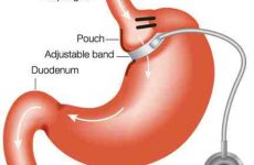 Νοσογόνος Παχυσαρκία: Γιατί ο γαστρικός δακτύλιος αποτυγχάνει;