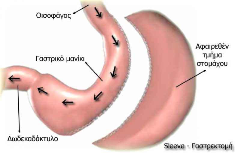Γαστρικό Μανίκι: Η επέμβαση που «εξαφανίζει» πείνα και βουλιμία