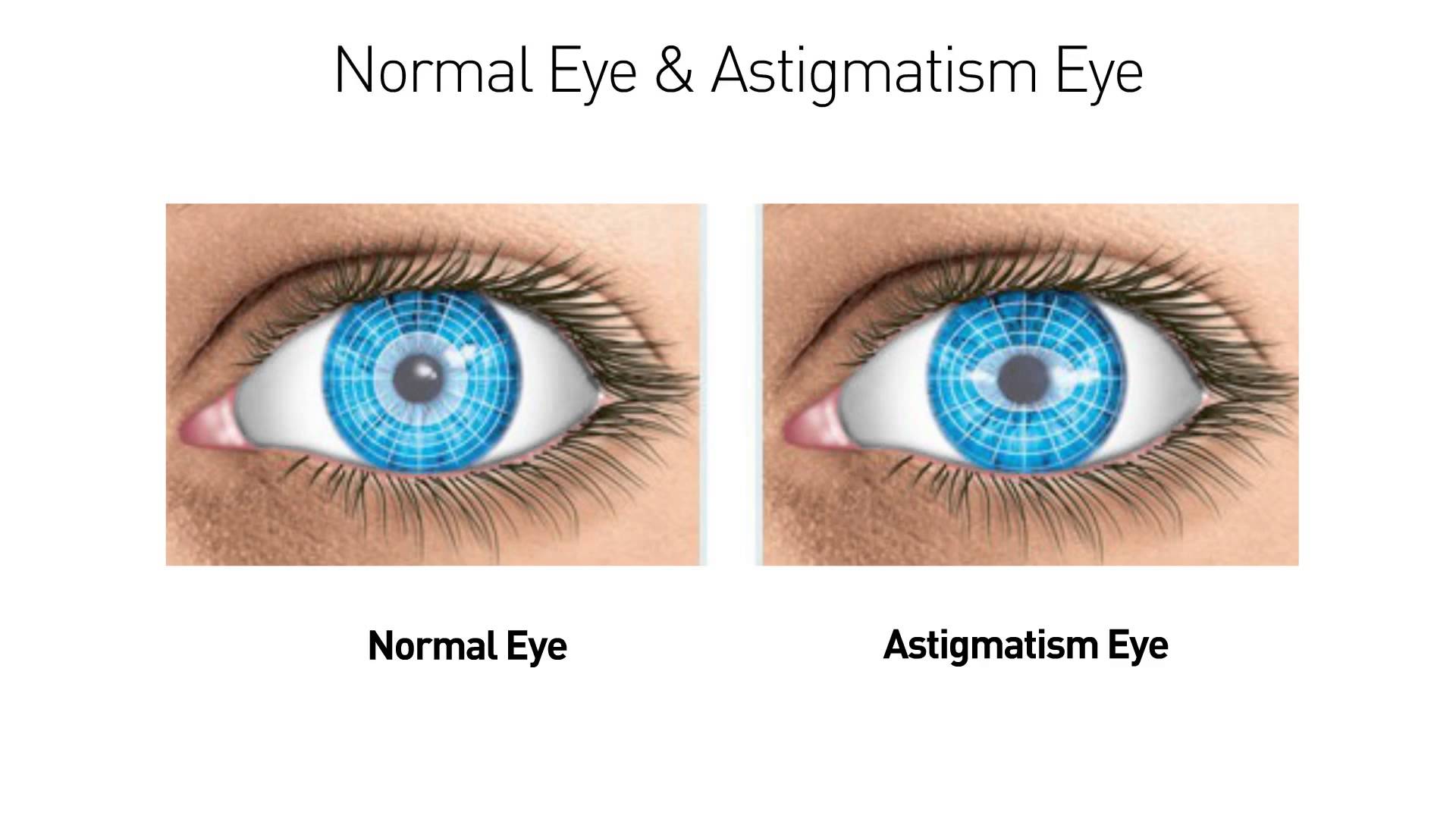 Когда после замены хрусталика восстанавливается зрение глаза. Астигматизм. Астигматизм гимнастика для глаз. Упражнения для астигматизма. Упражнения для глаз от астигматизма.