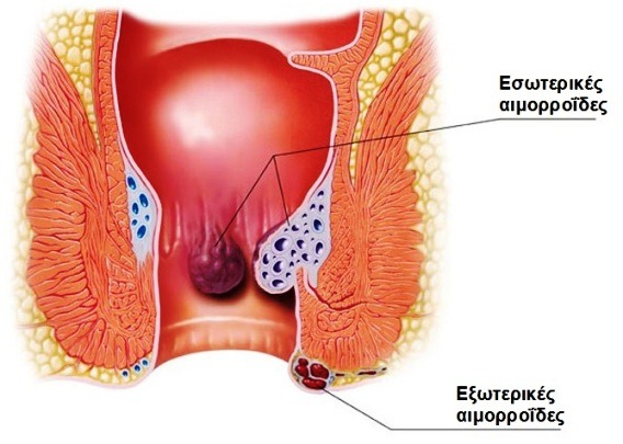 Ριζική θεραπεία των αιμορροΐδων