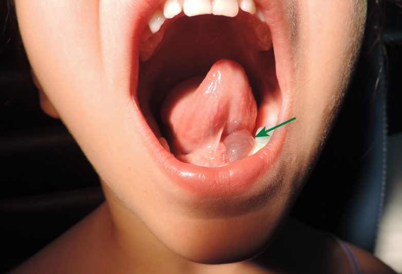 Βατράχιο στο στόμα: Οριστική λύση δίνει το χειρουργείο