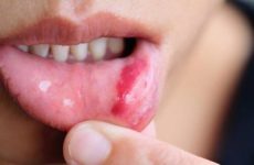Ύποπτα σημάδια που δηλώνουν την εμφάνιση καρκίνου στο στόμα