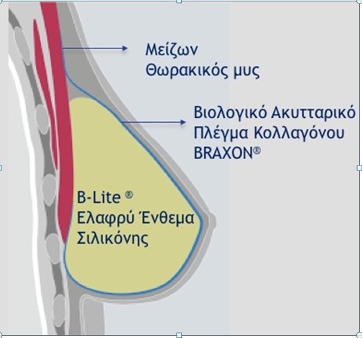 Καινοτόμος μέθοδος ιατρών για την άμεση αποκατάσταση μαστού